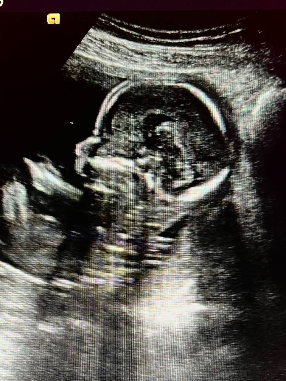 Ecografía del bebé